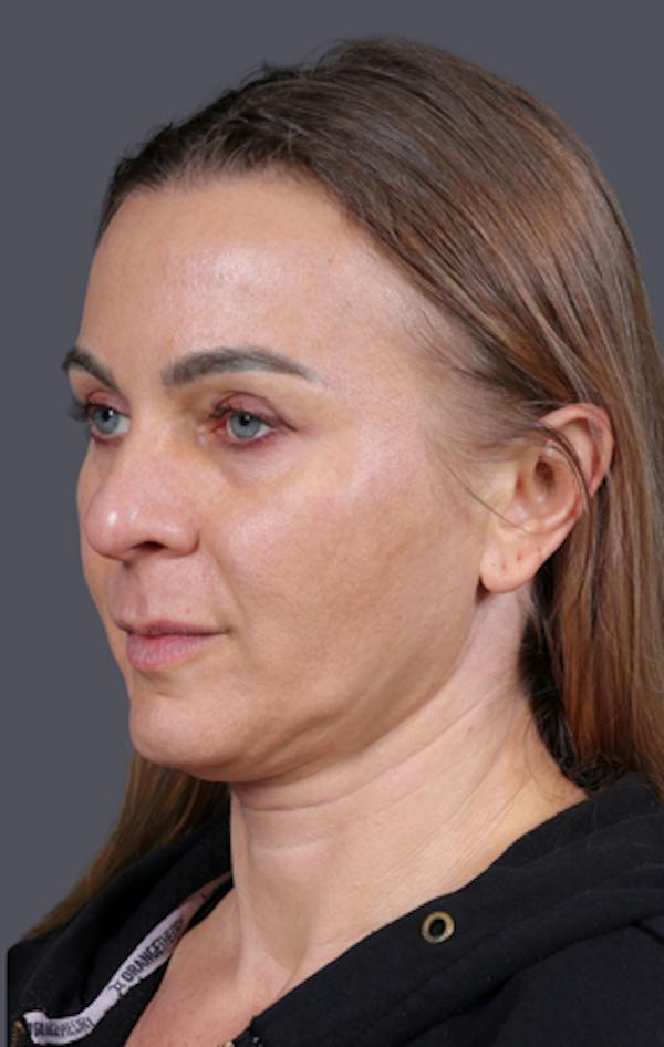 Facelift Before & After Gallery - Patient 121801 - Image 7