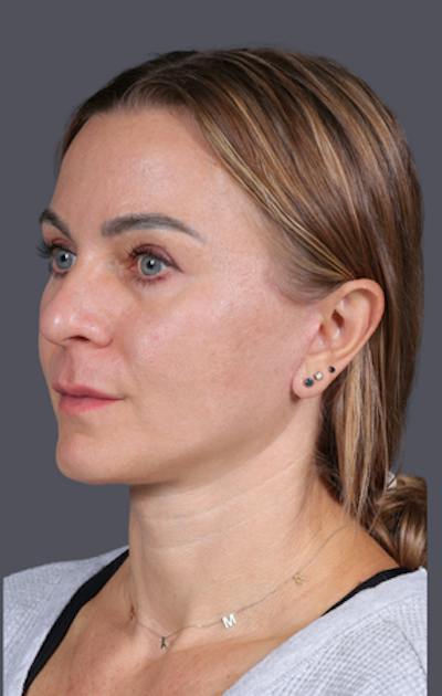 Facelift Before & After Gallery - Patient 121801 - Image 8