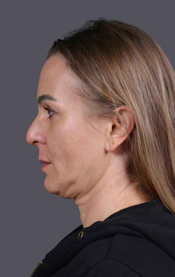 Facelift Before & After Gallery - Patient 121801 - Image 9