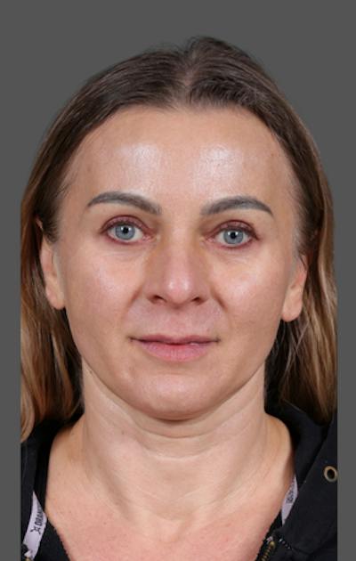 Facelift Before & After Gallery - Patient 121801 - Image 1