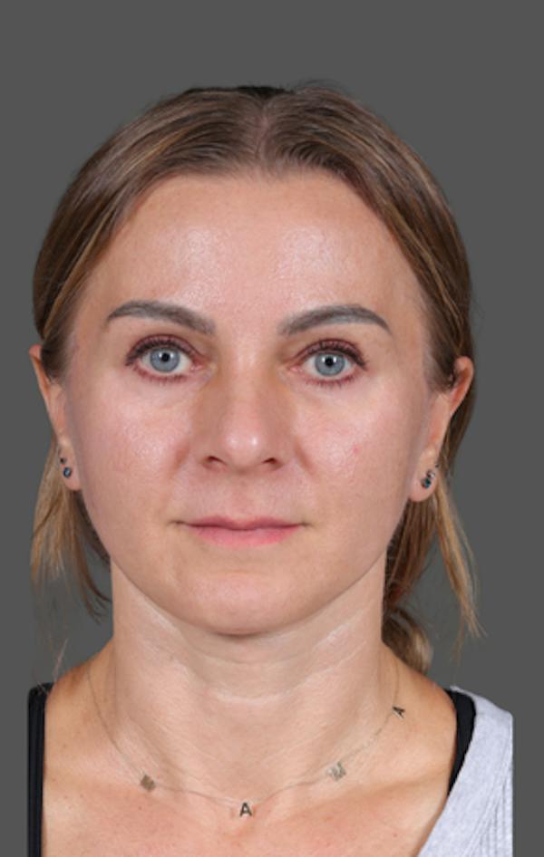Facelift Before & After Gallery - Patient 121801 - Image 2