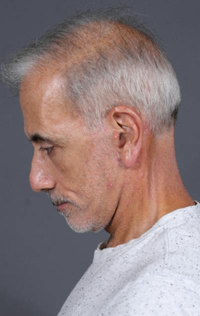 Facelift Before & After Gallery - Patient 397045 - Image 14
