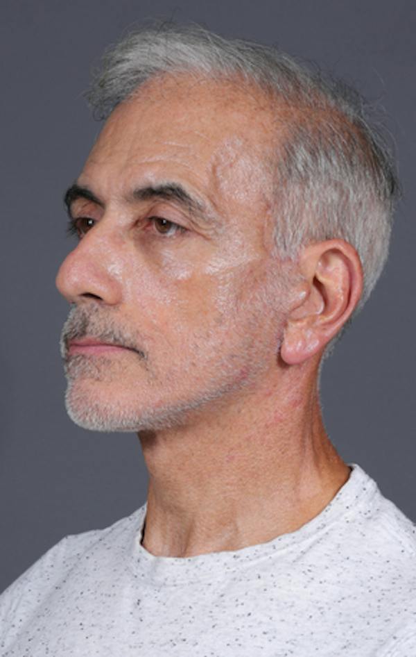 Facelift Before & After Gallery - Patient 397045 - Image 10