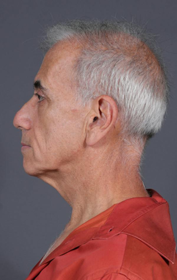Facelift Before & After Gallery - Patient 397045 - Image 11