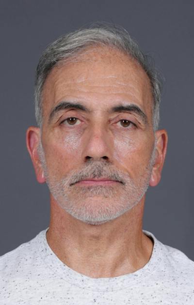 Facelift Before & After Gallery - Patient 397045 - Image 2