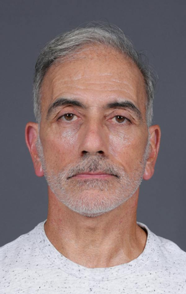 Facelift Before & After Gallery - Patient 397045 - Image 2