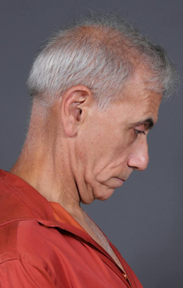 Facelift Before & After Gallery - Patient 397045 - Image 7