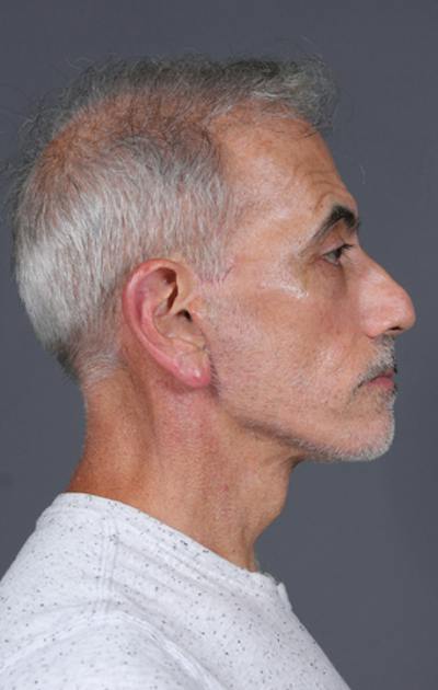 Facelift Before & After Gallery - Patient 397045 - Image 6