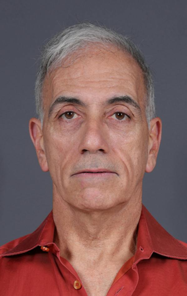 Facelift Before & After Gallery - Patient 397045 - Image 1