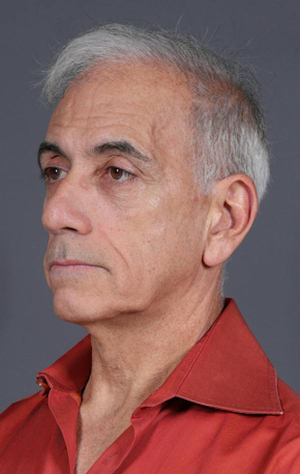 Facelift Before & After Gallery - Patient 397045 - Image 9