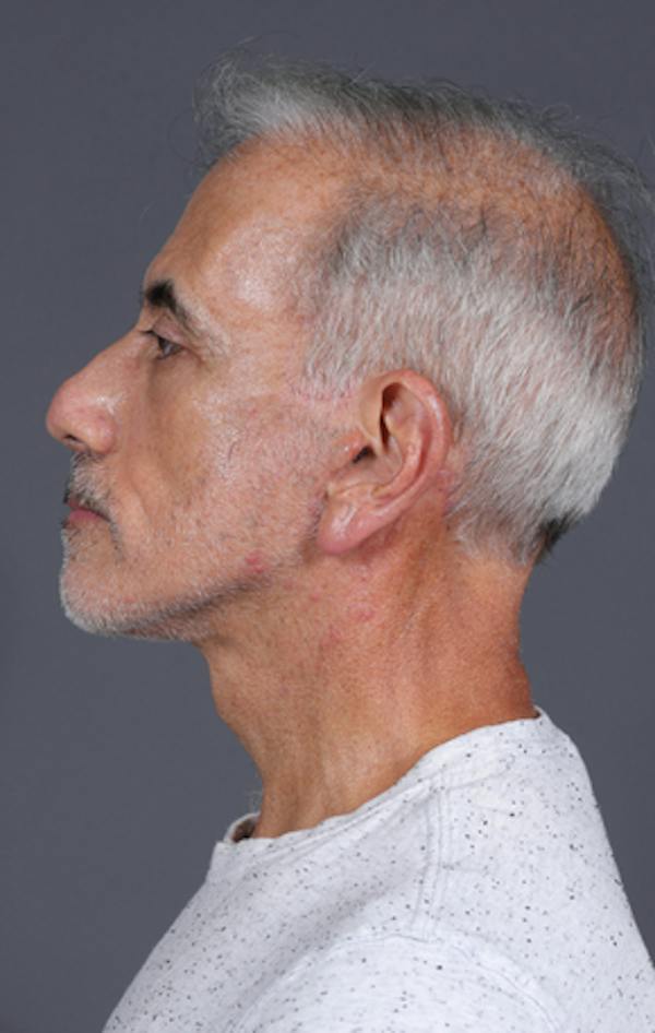 Facelift Before & After Gallery - Patient 397045 - Image 12