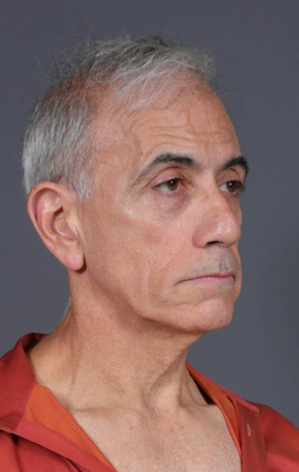 Facelift Before & After Gallery - Patient 397045 - Image 3