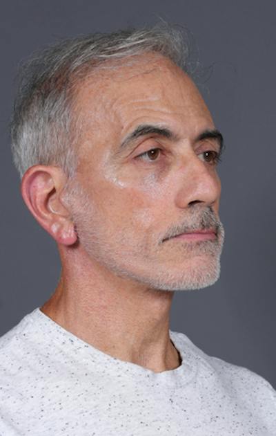 Facelift Before & After Gallery - Patient 397045 - Image 4
