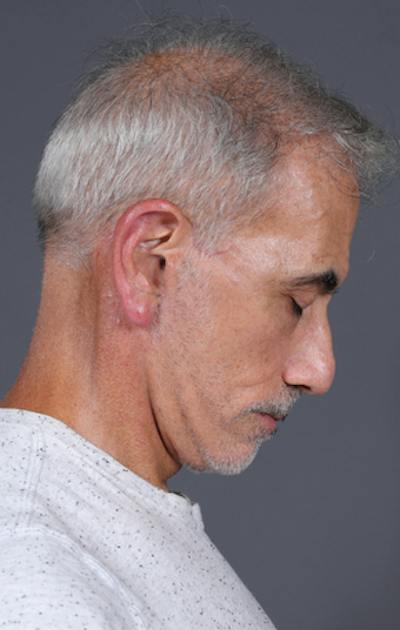 Facelift Before & After Gallery - Patient 397045 - Image 8
