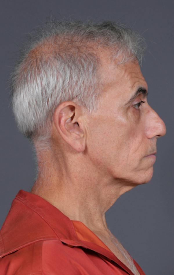 Facelift Before & After Gallery - Patient 397045 - Image 5