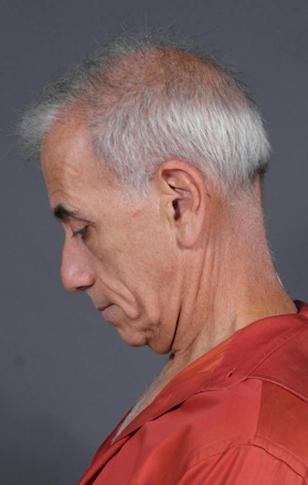Facelift Before & After Gallery - Patient 397045 - Image 13