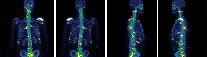 Bone scan images