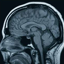 MRI scan of the brain