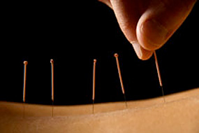 person receiving accupuncture therapy