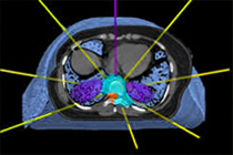 Stereotactic Body Radiotherapy Los Angeles
