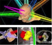 #D computer generated image of how radiation affects the brain 