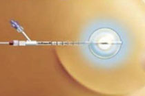 HDR Brachytherapy Los Angeles