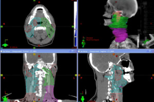 Radiation therapy treatment in Los Angeles