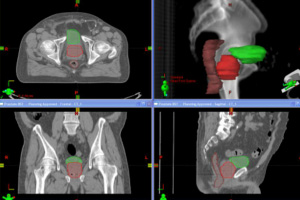 External Radiation Therapy Los Angeles