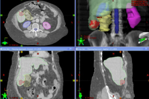 Cyberknife Radiation Los Angeles