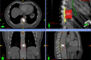 SBRT Treatment Los Angeles