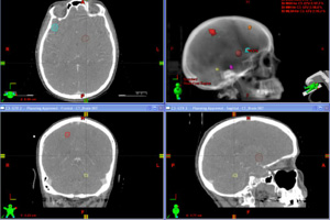 Stereotactic Radiation Therapy Los Angeles