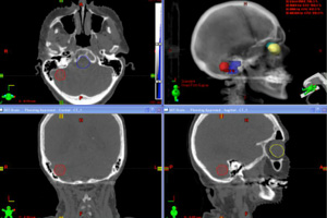 Stereotactic Radiation Therapy Los Angeles