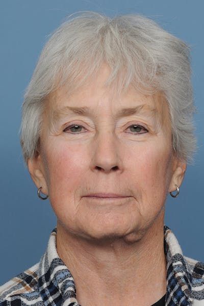Facelift Before & After Gallery - Patient 8376407 - Image 1