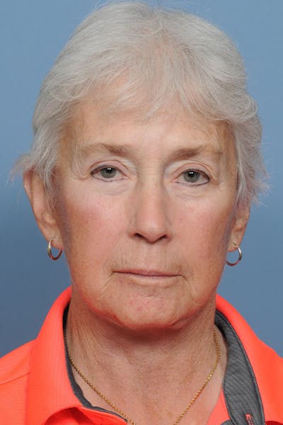 Facelift Before & After Gallery - Patient 8376407 - Image 2