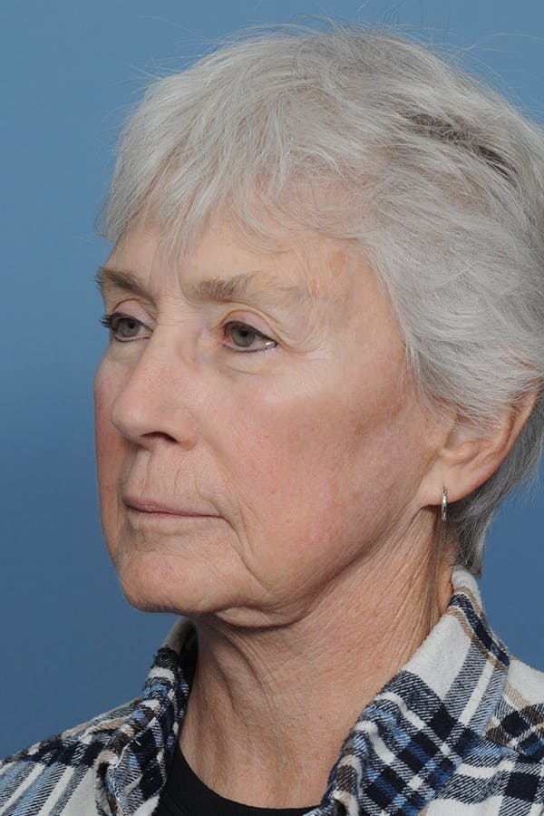 Facelift Before & After Gallery - Patient 8376407 - Image 5