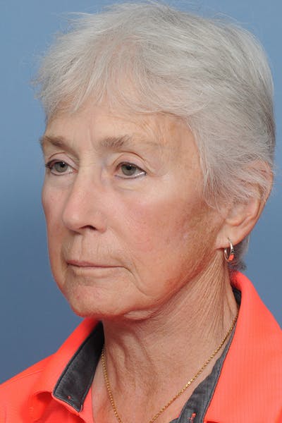 Facelift Before & After Gallery - Patient 8376407 - Image 6