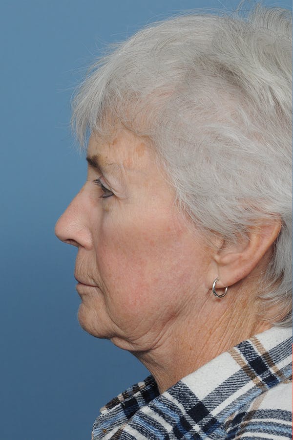 Facelift Before & After Gallery - Patient 8376407 - Image 3