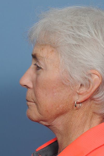 Facelift Before & After Gallery - Patient 8376407 - Image 4