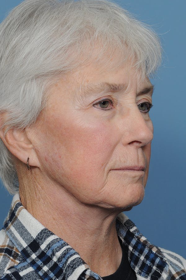 Facelift Before & After Gallery - Patient 8376407 - Image 9