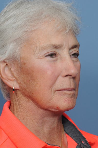 Facelift Before & After Gallery - Patient 8376407 - Image 10