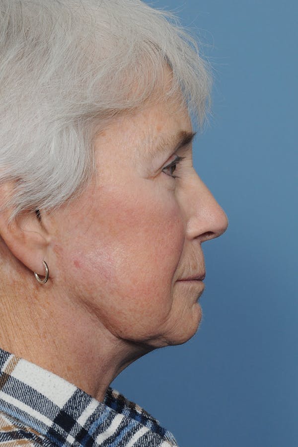 Facelift Before & After Gallery - Patient 8376407 - Image 7