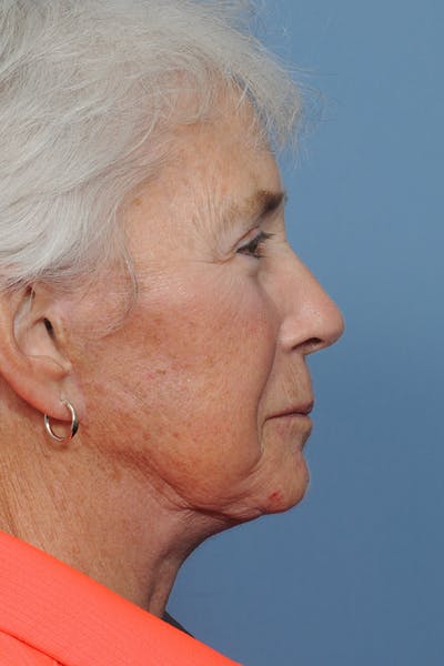 Facelift Before & After Gallery - Patient 8376407 - Image 8