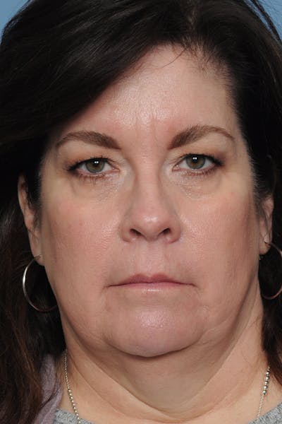 Eyelid Lift Before & After Gallery - Patient 8376631 - Image 1