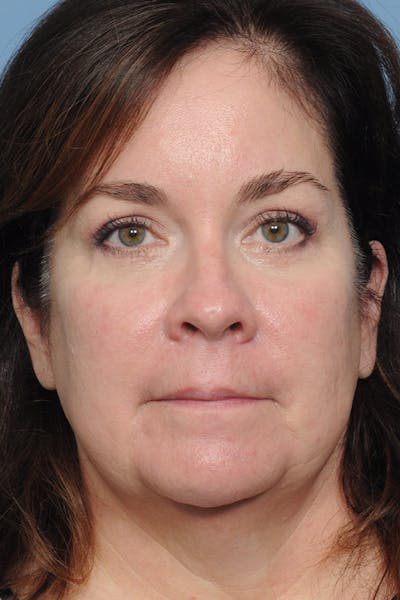 Brow Lift Before & After Gallery - Patient 8376514 - Image 2