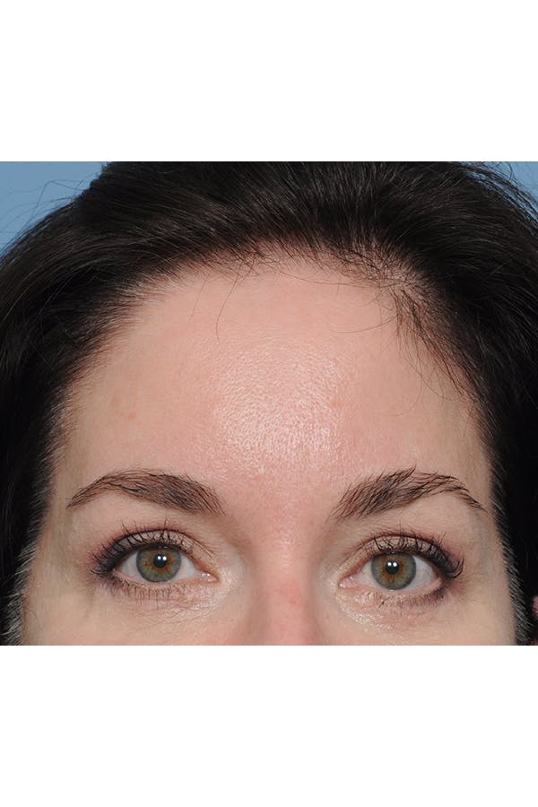 Brow Lift Before & After Gallery - Patient 8376514 - Image 4