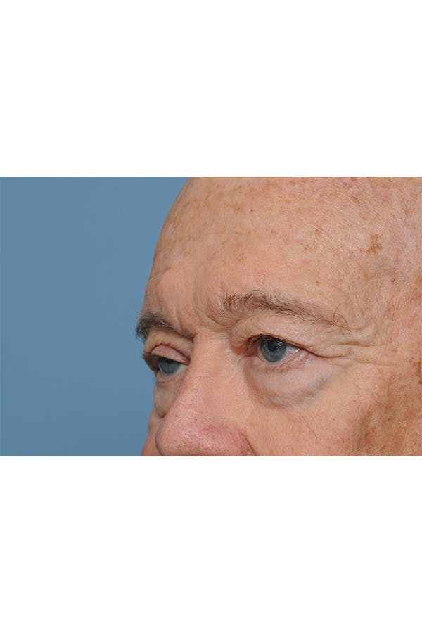 Eyelid Lift Before & After Gallery - Patient 8376646 - Image 7