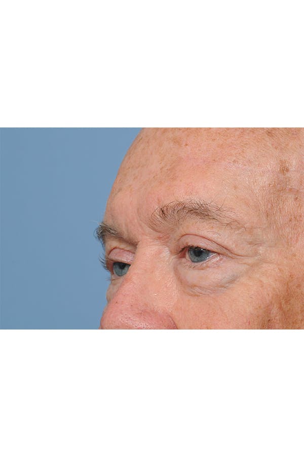 Eyelid Lift Before & After Gallery - Patient 8376646 - Image 8