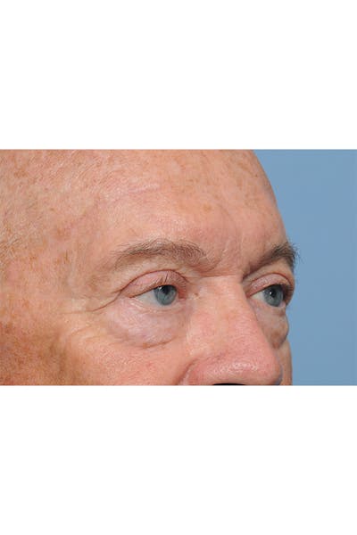 Eyelid Lift Gallery - Patient 8376646 - Image 12