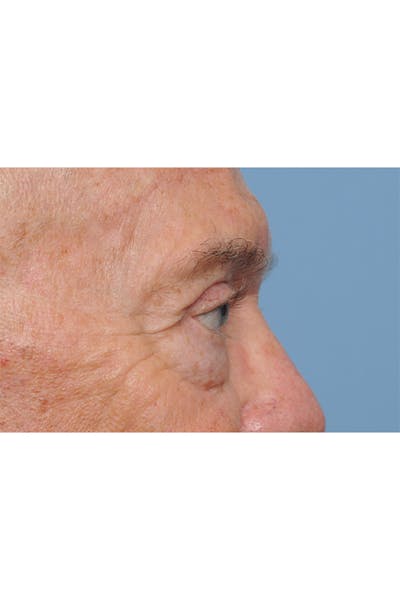 Eyelid Lift Before & After Gallery - Patient 8376646 - Image 10