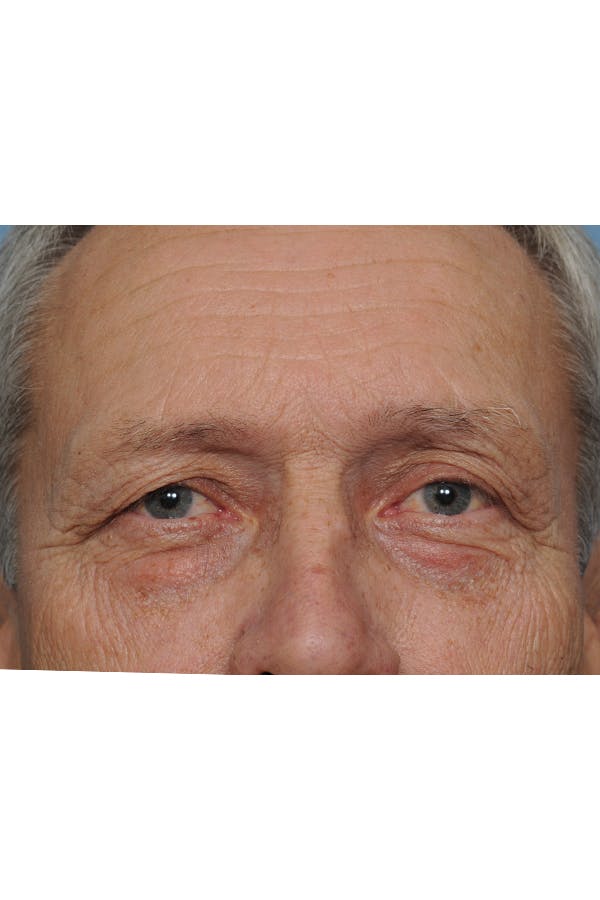 Eyelid Lift Before & After Gallery - Patient 8376666 - Image 3